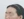 Forehead reduction (hairline lowering surgery) — after (8days) · Goyu Plastic Surgery Clinic