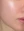 Superficial chemical peel (Korean 'skin scaling') — after (14days) · A-Top Plastic Surgery Clinic