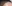 生え際の植毛（ヘアライン植毛） — バンスモザイナークリニック