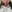 Double chin liposuction (submental liposuction) — Seoul During Clinic