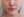 Oligio / Oligio X (โอลิจิโอ) — หลังทำ (30วัน) · เยพึนออลกุลคลินิก