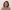 Double chin liposuction (submental liposuction) — Soda Plastic Surgery Clinic