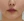 Botox for nasolabial folds — after (8days) · VS Line Clinic - Incheon Guwol Branch