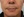 JUVGEN (autologous dermal regeneration / collagen-induction injection) — before (14days) · Saeroun Plastic Surgery
