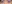 裏ハムラ法（経結膜的眼窩脂肪移動術） — プレジャー美容外科クリニック