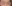 裏ハムラ法（経結膜的眼窩脂肪移動術） — プレジャー美容外科クリニック