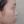 小鼻縮小 — 術前 (180日) · プレジャー美容外科クリニック