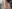 Arm liposuction — Model Line Clinic - Gangnam Branch
