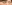 裏ハムラ法（経結膜的眼窩脂肪移動術） — ファクト美容外科クリニック
