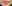 唇のヒアルロン酸注入（リップヒアルロン酸） — ドレス美容外科クリニック