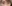 裏ハムラ法（経結膜的眼窩脂肪移動術） — ウリ美容外科クリニック