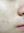 皮下分离术（Subcision，痘坑松解） — 术前 (56天) · Erne诊所