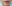 Lip filler (lip augmentation with HA) — Maison de M Clinic
