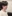 団子鼻修正（鼻尖縮小術） — ヒューマン美容外科