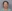 lower blepharoplasty (under-eye bag removal with fat repositioning) — Saegim Plastic Surgery Clinic
