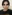 Bulbous nose correction (surgical nasal tip reduction) — DM Plastic Surgery Clinic