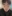 Lower Eyelid Fat Repositioning (transconjunctival) — Pleasure Plastic Surgery Clinic