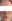 Nasal Tip Plasty with Autologous Cartilage — Litmus Plastic Surgery