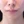 ศัลยกรรมยกริมฝีปากบน (Lip Lift) — ก่อนทำ (7วัน) · ไฮบอม ศัลยกรรมพลาสติก