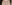 裏ハムラ法（経結膜的眼窩脂肪移動術） — バイブ美容外科クリニック