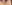 裏ハムラ法（経結膜的眼窩脂肪移動術） — ウィバース美容外科クリニック