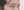 眼睑脂肪填充（上睑凹陷填充） — 术后 (7天) · 高唯医美诊所