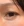 Eyelid filler (upper eyelid hollowing correction) — after (14days) · Wow Plastic Surgery