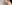 facial contouring injection (facial fat-dissolving injection) — J.Fill Clinic - Gangnam Branch