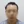 Hairline hair transplant (hairline lowering by grafting) — after (3days) · Vance Mosae Clinic