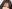 Ptosis Correction (levator surgery / eye-shape correction) — Luho Plastic Surgery Clinic
