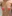 Hybrid breast augmentation (implant + fat grafting) — Dite Plastic Surgery Clinic