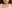 Corner lip lift (mouth corner lift) — Like Plastic Surgery Clinic