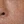 Clarity II (Lutronic dual-wavelength laser) — before (60days) · A-Top Plastic Surgery Clinic