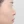 Nasal tip augmentation with donor (acellular) dermal matrix — before (30days) · AB Plastic Surgery & Skin Clinic