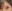 額リフト（前額リフト） — ムリ美容外科クリニック
