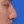 ผ่าตัดแก้ไขผนังกั้นช่องจมูกคด (Septoplasty) — ก่อนทำ (14วัน) · คลินิกโคบิจู