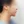 下巴異物取出（下巴假體移除） — 術前 (30天) · Returning醫美診所
