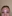 Forehead filler (hyaluronic acid) — Kody Plastic Surgery Clinic