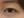 Eyelid filler (upper eyelid hollowing correction) — after (14days) · Wow Plastic Surgery