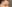 裏ハムラ法（経結膜的眼窩脂肪移動術） — メイト美容外科クリニック