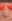 Bulbous nose correction (surgical nasal tip reduction) — Eight Plastic Surgery Clinic