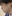 人中短縮（リップリフト） — プランナー美容外科クリニック