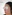 Bulbous nose correction (surgical nasal tip reduction) — Coco Line Clinic