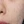 Clarity II (Lutronic dual-wavelength laser) — before (60days) · A-Top Plastic Surgery Clinic
