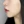 Volnewmer (โวลนิวเมอร์ ยกกระชับด้วย RF) — หลังทำ (14วัน) · เอท็อปคลินิกศัลยกรรมพลาสติก