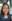 Epicanthoplasty reversal (canthoplasty revision / eye-opening restoration) — Mate Plastic Surgery Clinic