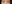 Lower Eyelid Fat Repositioning (transconjunctival) — Pleasure Plastic Surgery Clinic