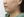 Ultraformer III (อัลตร้าฟอร์เมอร์) — ก่อนทำ · BLS Clinic - สาขาหลัก