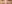 裏ハムラ法（経結膜的眼窩脂肪移動術） — アンド美容外科クリニック