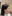 頬（ほお）の脂肪注入 — プレジャー美容外科クリニック